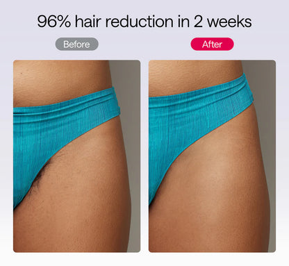 Bevelle™ Smooth IPL Hair Removal